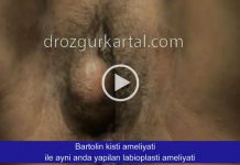 Bartolin Apsesi Ameliyatı ile Aynı Zamanda Yapılan Genital Estetik Ameliyatı Videosu